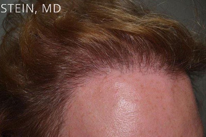 Hair for Gender Reaffirmation Before & After Gallery - Patient 902722 - Image 10