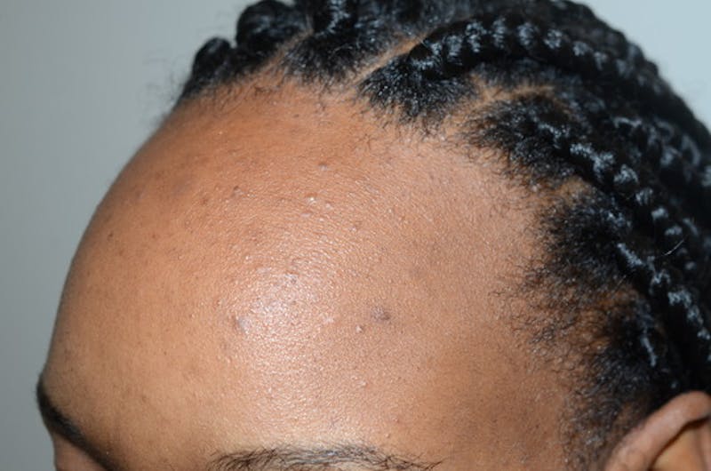 Hairline Lowering Surgery Before & After Gallery - Patient 435634 - Image 3
