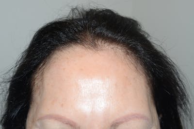 Hair Procedures for Women Before & After Gallery - Patient 285965 - Image 1
