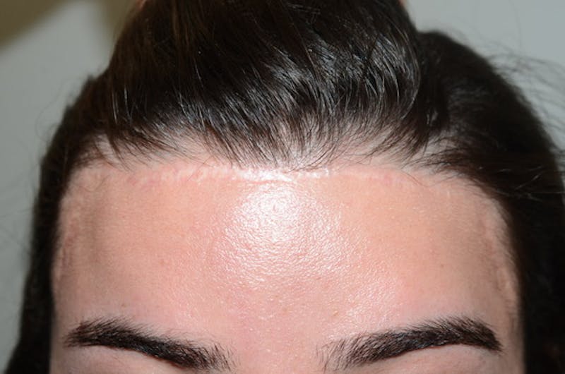 Hair for Gender Reaffirmation Before & After Gallery - Patient 616727 - Image 1
