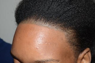 Hairline Lowering Surgery Before & After Gallery - Patient 391600 - Image 4
