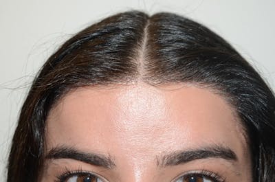 Hair For Gender Reaffirmation Before & After Gallery - Patient 328090 - Image 2