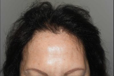 Hair Procedures for Women Before & After Gallery - Patient 285965 - Image 2