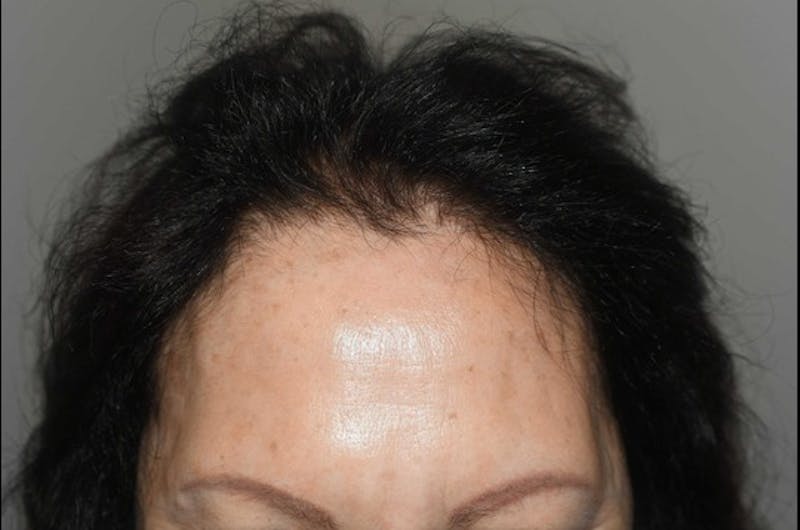 Hair Procedures for Women Before & After Gallery - Patient 381295 - Image 2