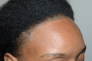 Hairline Lowering Surgery Before & After Gallery - Patient 391600 - Image 6