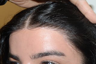 Hair for Gender Reaffirmation Before & After Gallery - Patient 616727 - Image 4