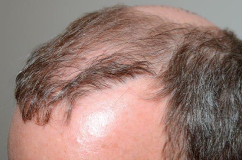 Hair Restoration for Men Before & After Gallery - Patient 230655 - Image 1