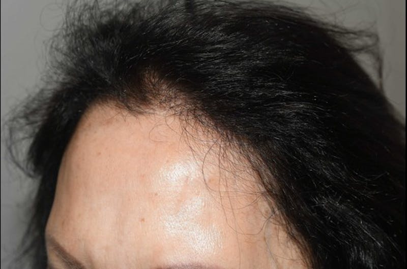 Hair Procedures for Women Before & After Gallery - Patient 381295 - Image 4
