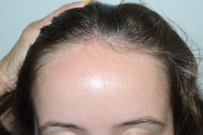 Hairline Lowering Surgery Before & After Gallery - Patient 441302 - Image 1