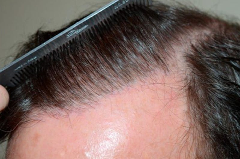 Hair Restoration for Men Before & After Gallery - Patient 230655 - Image 2