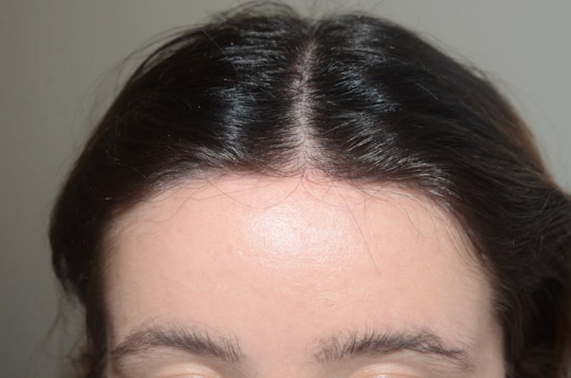 Hairline Lowering Surgery Before & After Gallery - Patient 226704 - Image 2