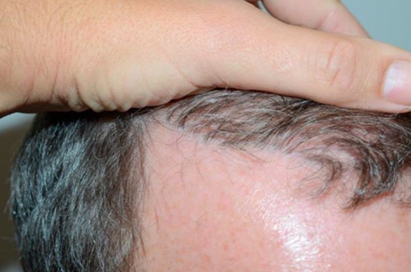 Hair Restoration for Men Before & After Gallery - Patient 230655 - Image 3