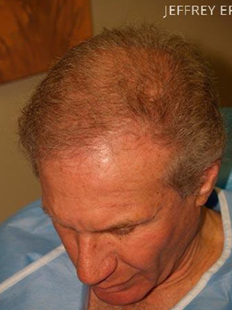 Hair Transplant Repair Before & After Gallery - Patient 144080 - Image 1