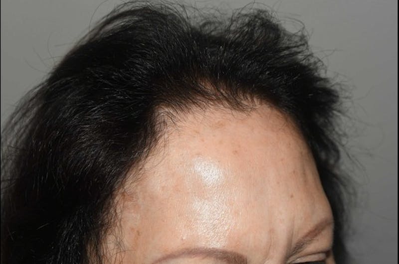 Hair Procedures for Women Before & After Gallery - Patient 381295 - Image 6