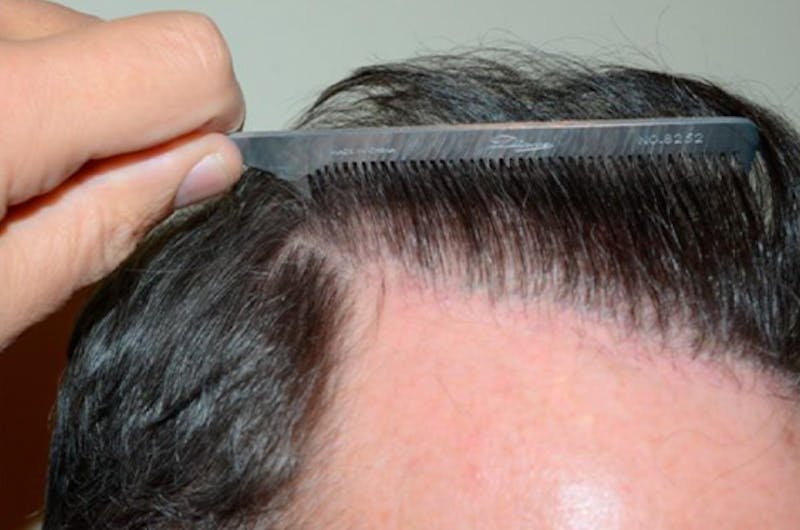 Hair Restoration for Men Before & After Gallery - Patient 230655 - Image 4
