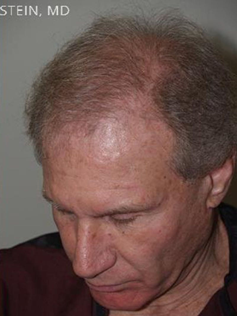 Hair Transplant Repair Before & After Gallery - Patient 144080 - Image 2
