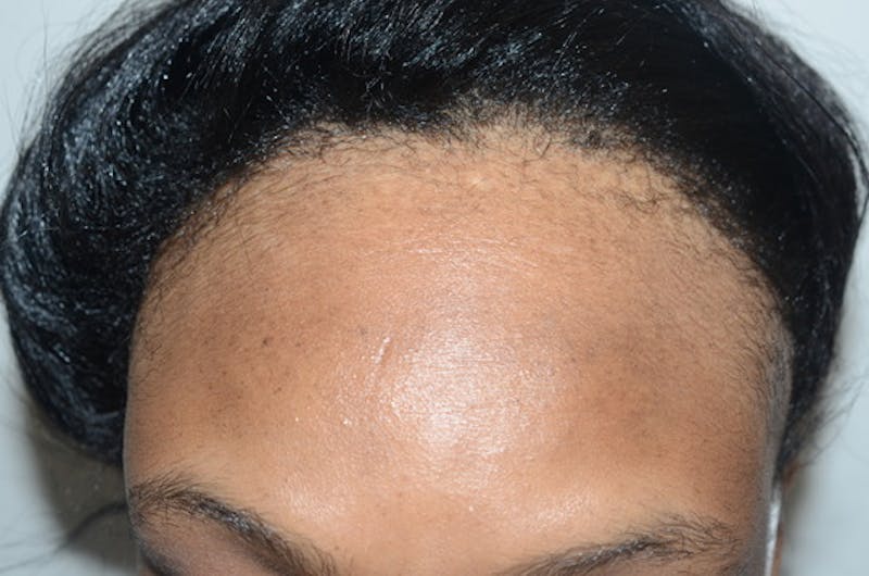 Hair Procedures for Women Before & After Gallery - Patient 389169 - Image 1