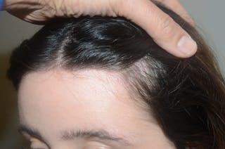 Hairline Lowering Surgery Before & After Gallery - Patient 400794 - Image 4