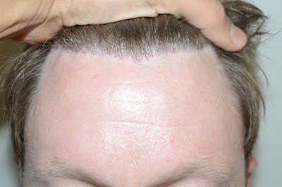 Hair Transplant Repair Before & After Gallery - Patient 158909 - Image 1