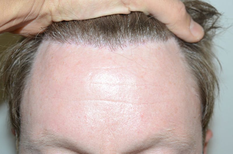 Hair Restoration for Men Before & After Gallery - Patient 210725 - Image 1