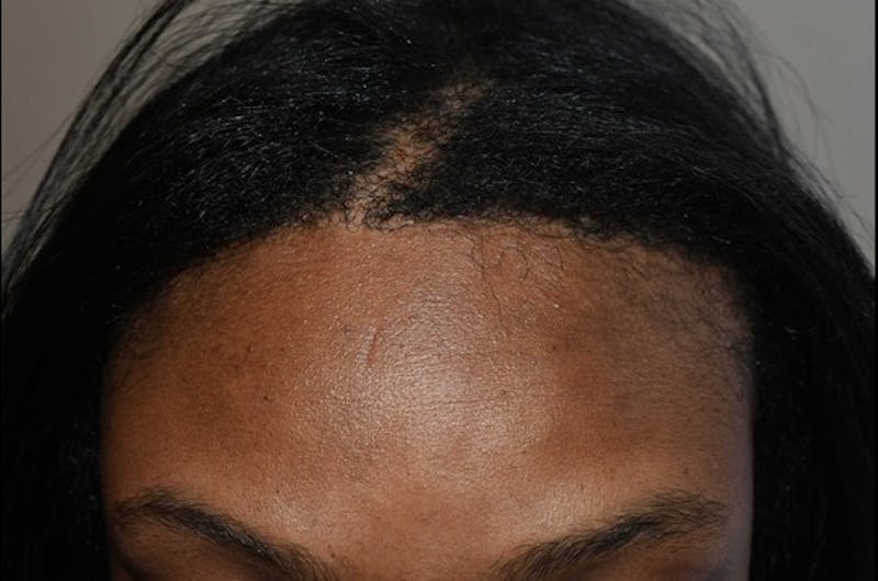 Hair Procedures for Women Before & After Gallery - Patient 389169 - Image 2