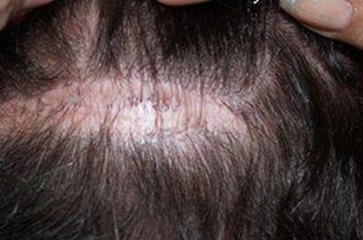 Hair Transplant Repair Before & After Gallery - Patient 372100 - Image 1