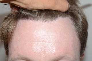 Hair Transplant Repair Before & After Gallery - Patient 158909 - Image 2