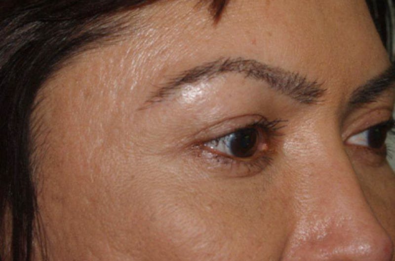 Hair for Gender Reaffirmation Before & After Gallery - Patient 346428 - Image 6