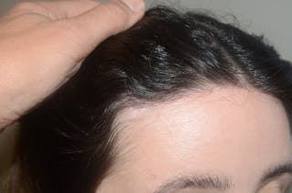 Hairline Lowering Surgery Before & After Gallery - Patient 400794 - Image 6