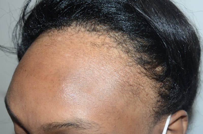 Hair Procedures for Women Before & After Gallery - Patient 389169 - Image 3