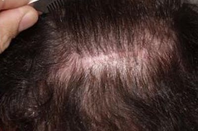 Hair Transplant Repair Before & After Gallery - Patient 372100 - Image 2