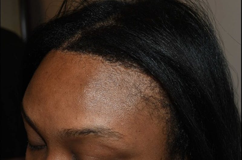 Hair Procedures for Women Before & After Gallery - Patient 389169 - Image 4