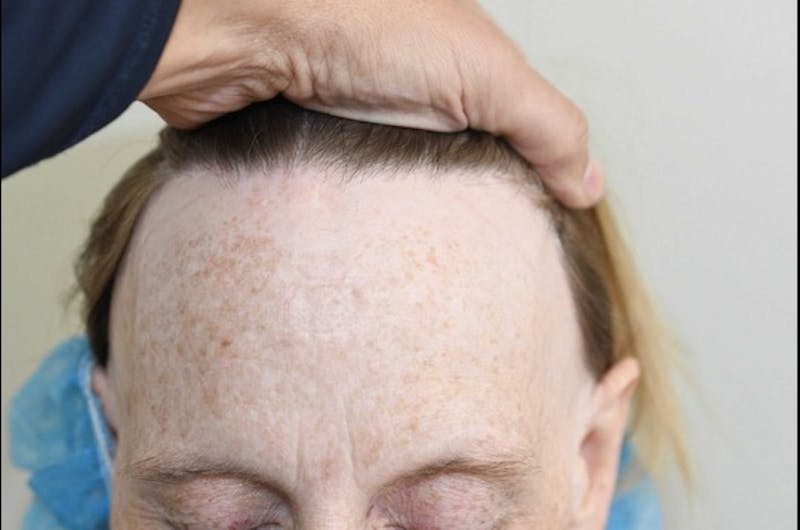 Hairline Lowering Surgery Before & After Gallery - Patient 414736 - Image 1