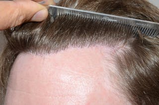 Hair Transplant Repair Before & After Gallery - Patient 158909 - Image 4