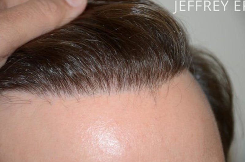 Hair Transplant Repair Before & After Gallery - Patient 127014 - Image 1