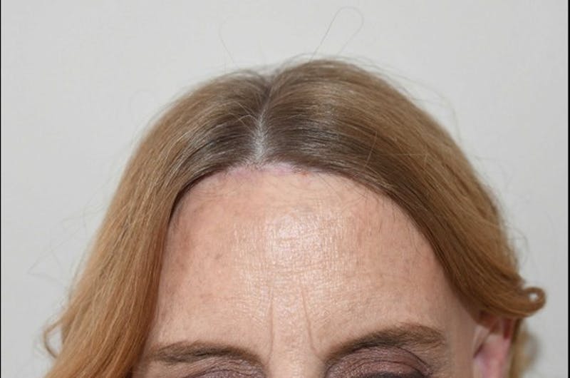 Hairline Lowering Surgery Before & After Gallery - Patient 414736 - Image 2