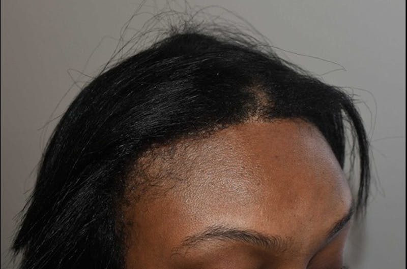 Hair Procedures for Women Before & After Gallery - Patient 389169 - Image 6