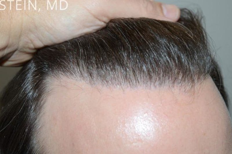 Hair Transplant Repair Before & After Gallery - Patient 127014 - Image 2