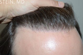Hair Transplant Repair Before & After Gallery - Patient 338416 - Image 2