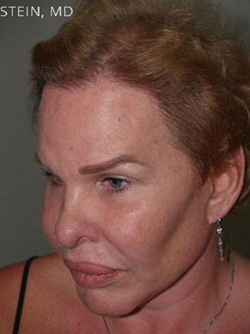 Hair for Gender Reaffirmation Before & After Gallery - Patient 902722 - Image 4