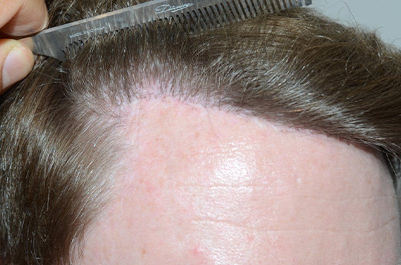 Hair Restoration for Men Before & After Gallery - Patient 210725 - Image 6