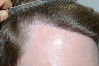 Hair Transplant Repair Before & After Gallery - Patient 158909 - Image 6