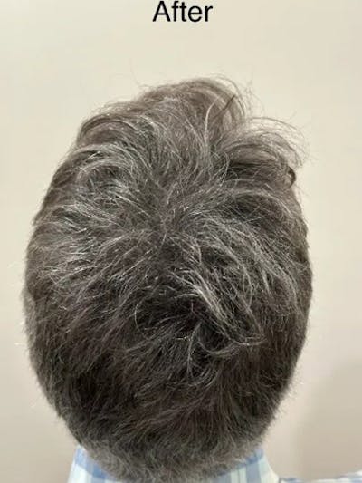 SMP Procedures Before & After Gallery - Patient 172521 - Image 2