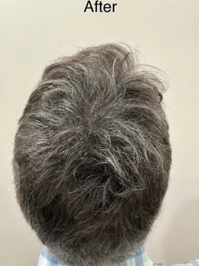 Scalp Micropigmentation Procedures Before & After Gallery - Patient 124759 - Image 2