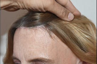 Hairline Lowering Surgery Before & After Gallery - Patient 271129 - Image 4