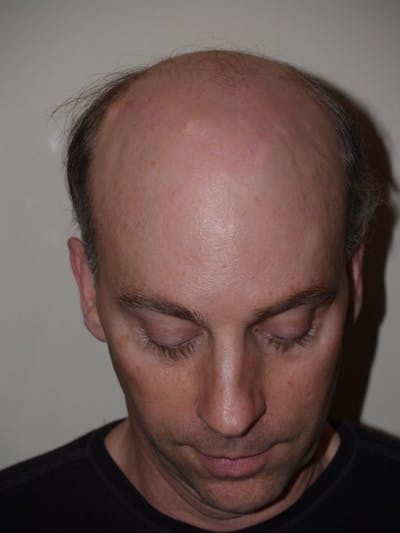 Special Cases Before & After Gallery - Patient 398463 - Image 2