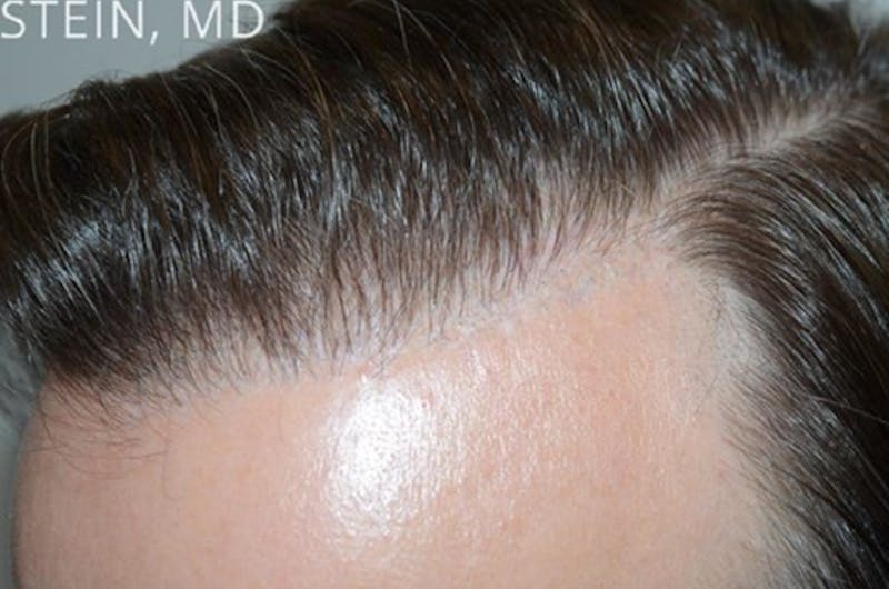 Hair Transplant Repair Before & After Gallery - Patient 127014 - Image 4