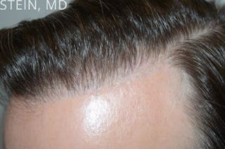 Hair Transplant Repair Before & After Gallery - Patient 338416 - Image 4