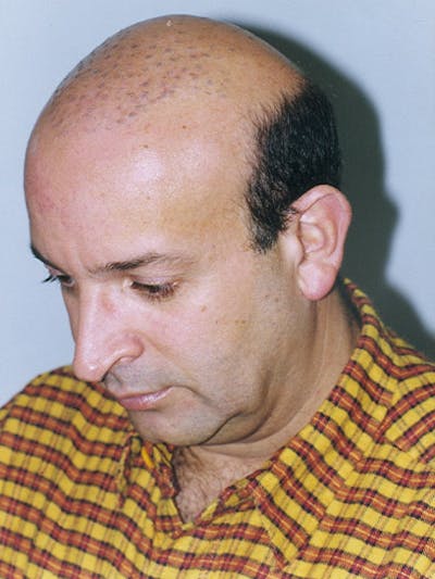 Hair Transplant Repair Before & After Gallery - Patient 285367 - Image 1