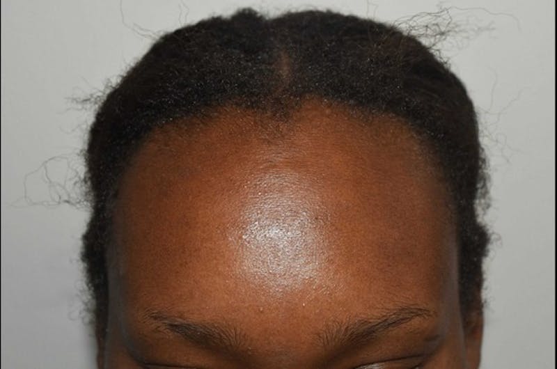 Hairline Lowering Surgery Before & After Gallery - Patient 209152 - Image 1